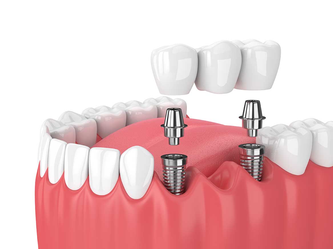 Implant dentaire : Quelles sont les qualités de l’implant ?